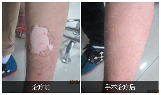 母液细胞植补术